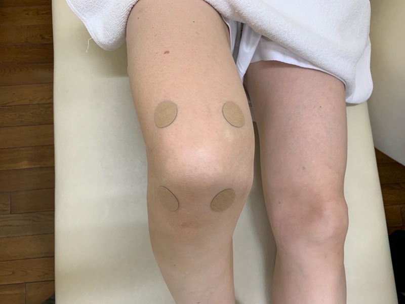 半月板の手術後、膝の痛みを軽くしてリハビリをしやすくするためには？